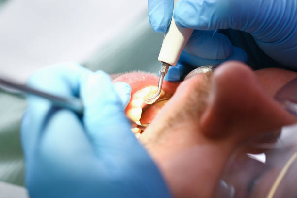 Best Broken or Chipped Tooth Repair in Cutler, CA