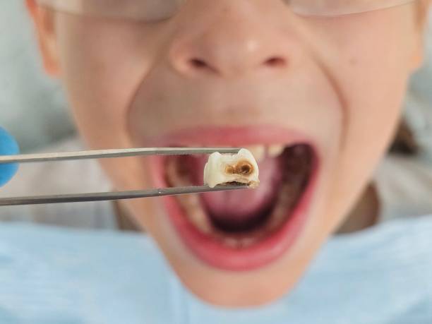 Best Emergency Root Canal Therapy in Cutler, CA